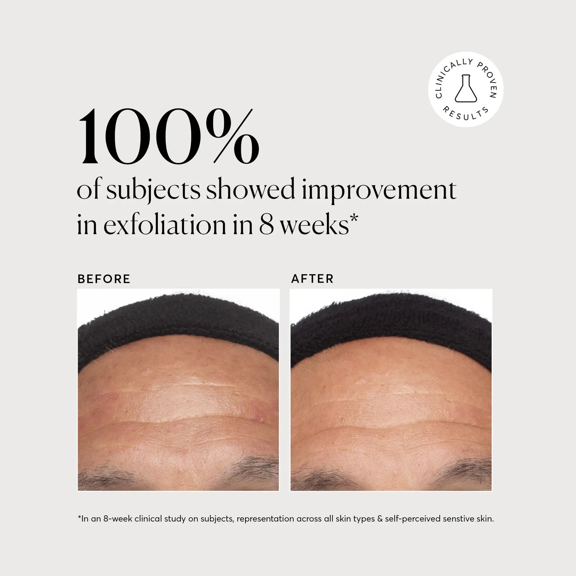 Azelaic Acid Derivative Complex 10% - Jumbo
